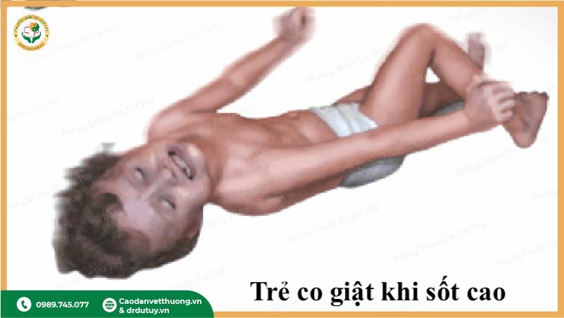 sốt cao co giật, cách xử trí trẻ co giật